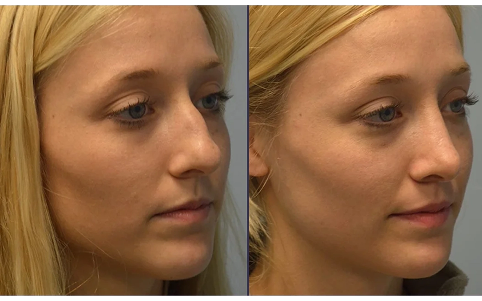 Rinoplastia Ultrasónica